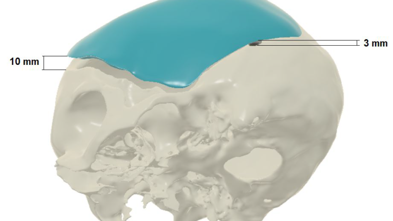 Png Clipart Jaw Implant Skull Cranioplasty Surgery Skull Face Head